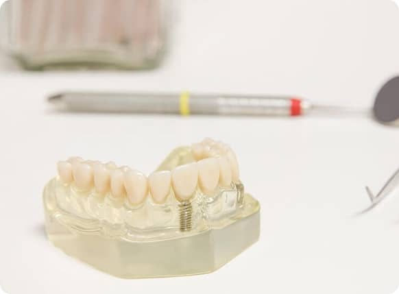implant dentaire blanc