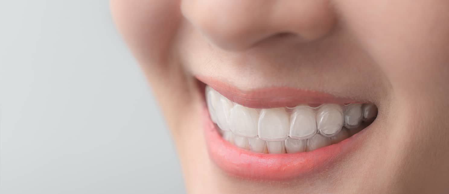 10 choses à savoir avant de débuter un traitement Invisalign | Centre Dentaire Sourire Concept