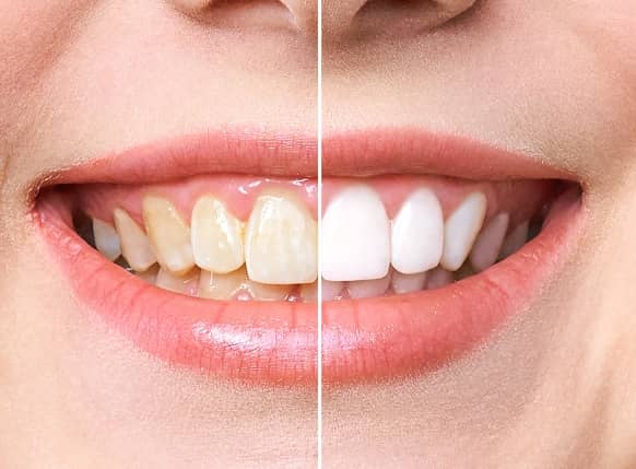 avant-après blanchiment dentaire