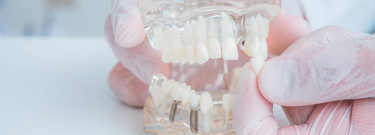 modèle implants dentaires